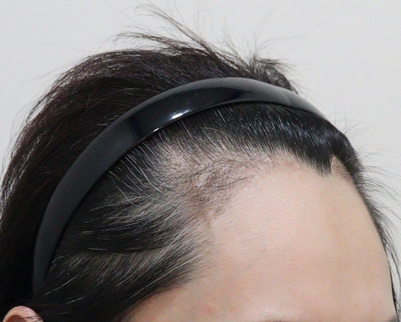 3. 수술후_3개월_3.JPG