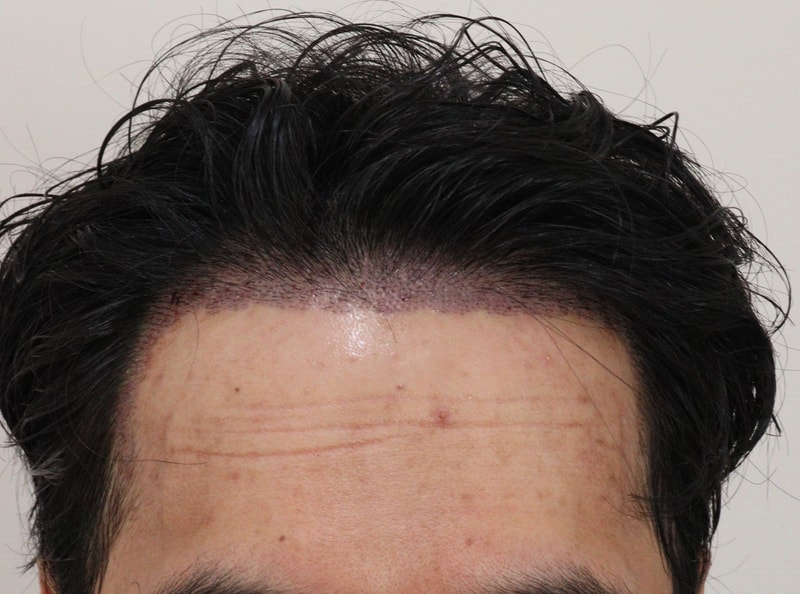 2. 수술후_1일_1.JPG