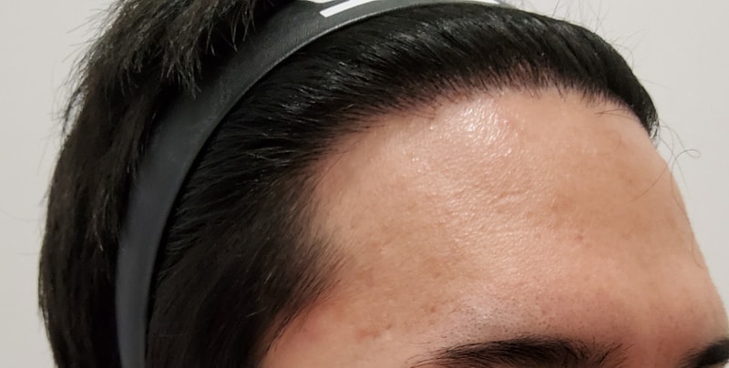 5. 수술후_1년_3.jpg