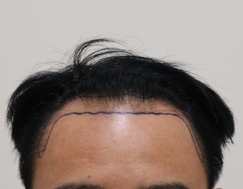 非切開 ヘアライン 毛髪移植 4100本