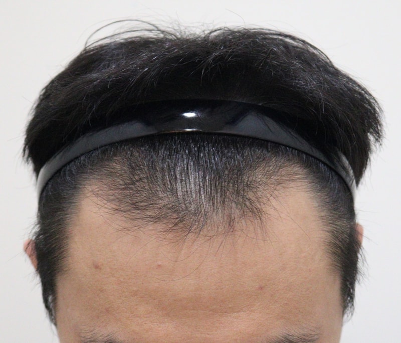 Hello~ I'm sharing the review of non-intersected hair transplantation.