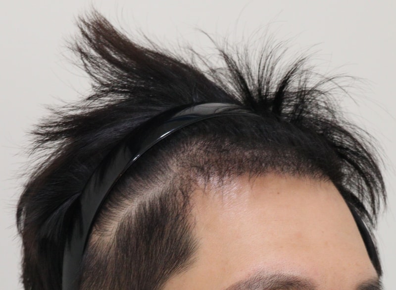 4. 수술후_5개월_3.JPG