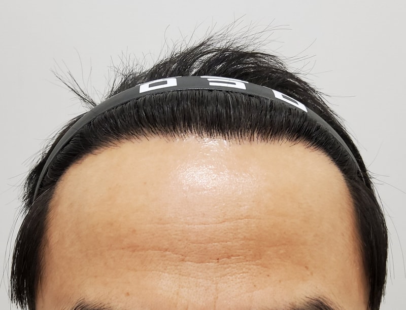 수술후_1년_1.jpg