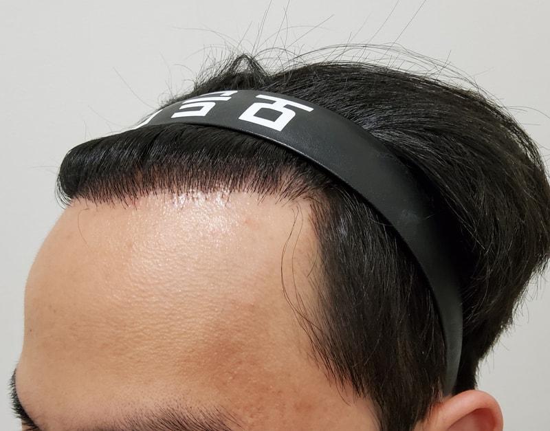 6. 수술후_1년_3.jpg