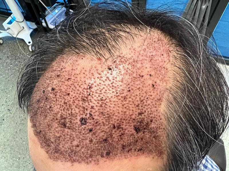 2. 수술후_1일_1.jpg