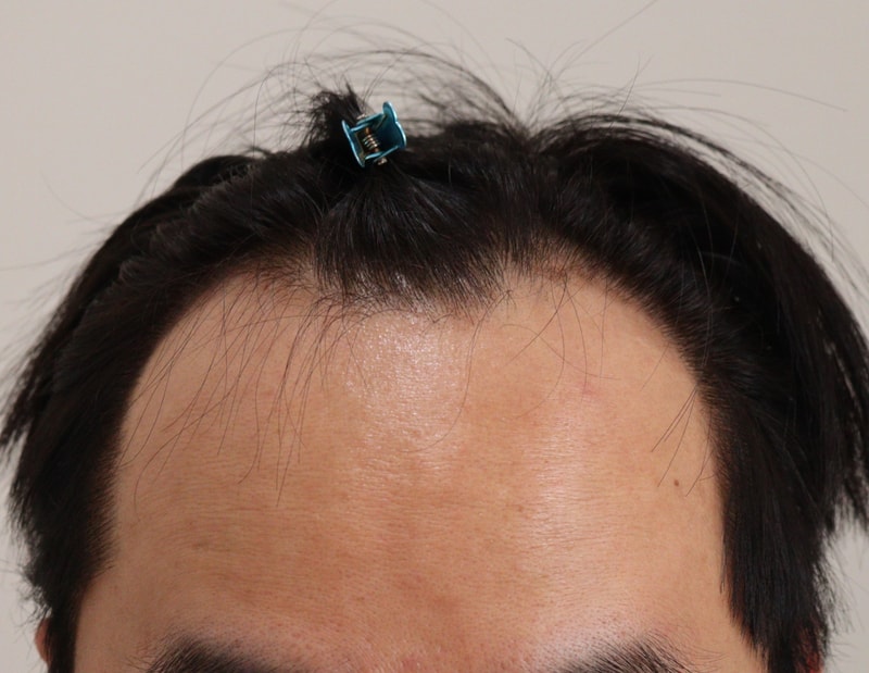 모앤블레스 M자탈모 모발이식 6개월차