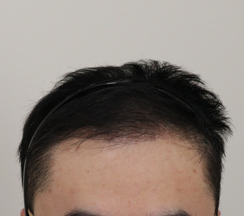 3. 수술후_3개월_1.JPG