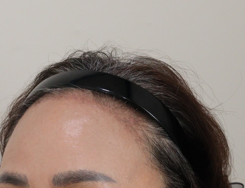 3. 수술후_3개월_2.JPG