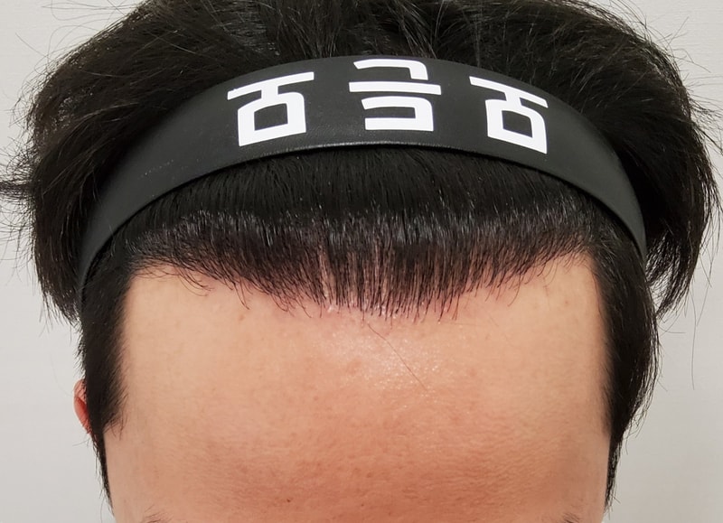 6. 수술후_1년_1.jpg