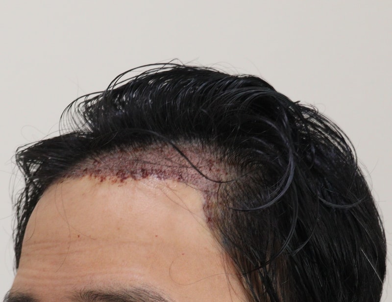 2. 수술후_1일_2.JPG