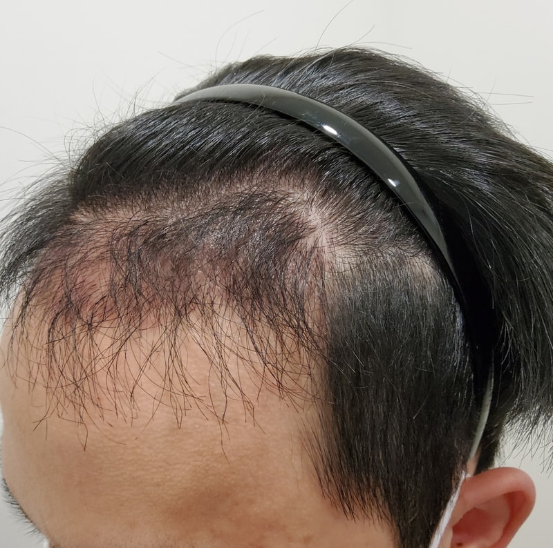 4. 수술후_3개월_2.jpg