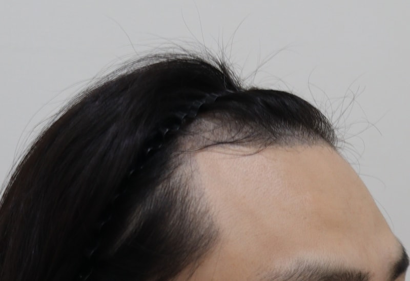 1. 수술전_2.JPG