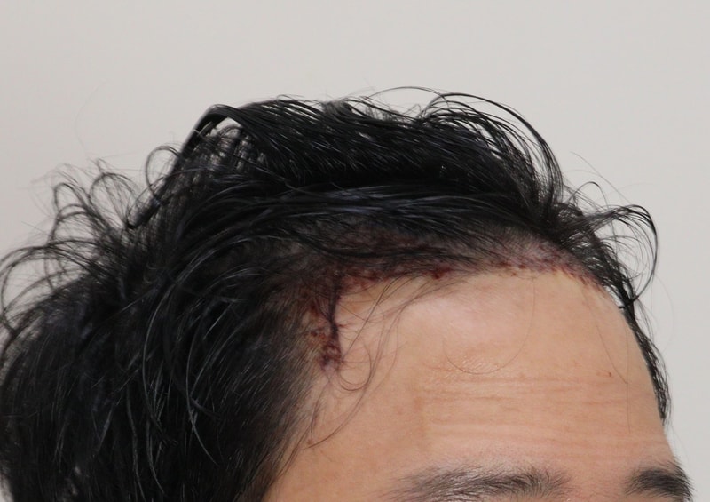 2. 수술후_1일_3.JPG