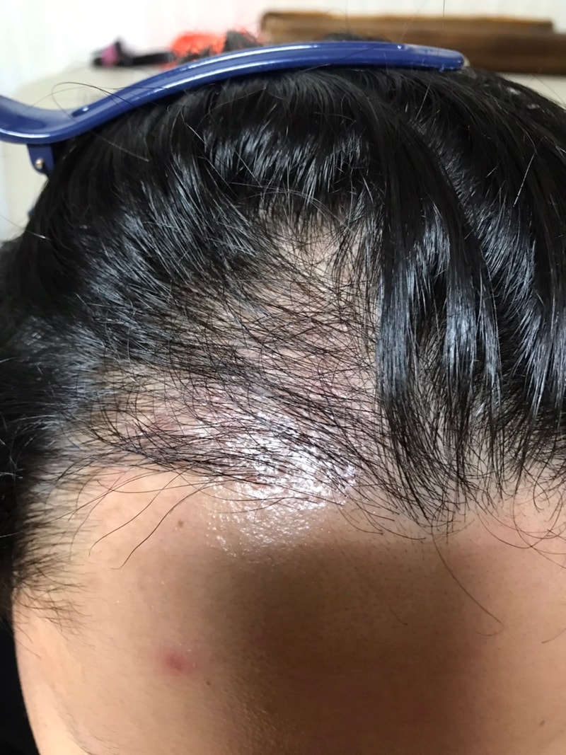 3. 수술후_3개월_셀카_3.jpg