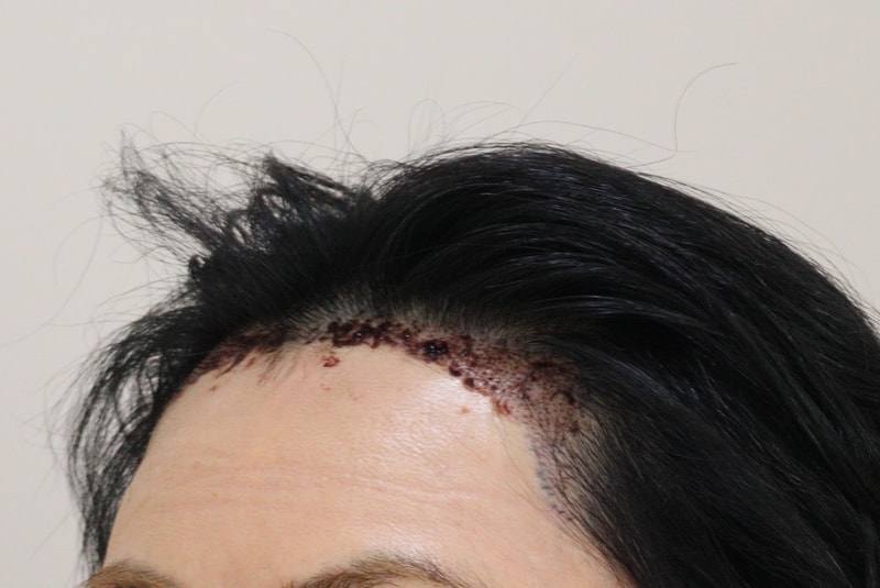 2. 수술후_1일_2.JPG