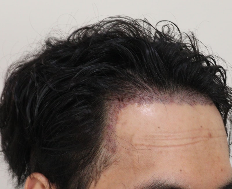 2. 수술후_1일_3.JPG