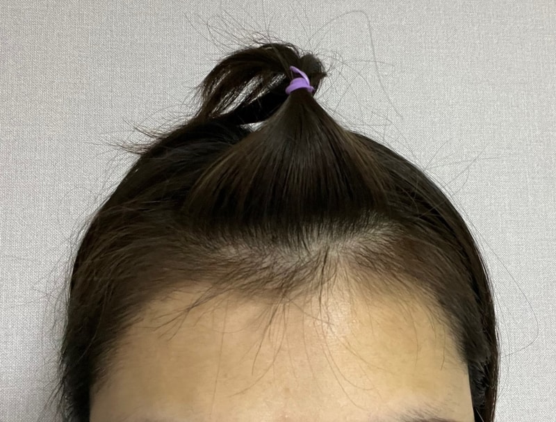 3. 수술후_3개월_셀카1.jpg