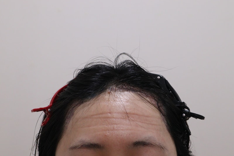 2. 수술후_1.JPG