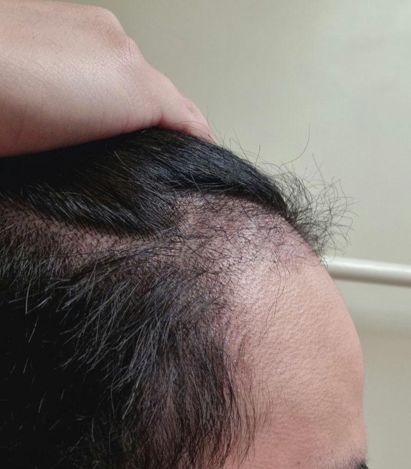 4. 수술후_3개월_셀카_3.jpg