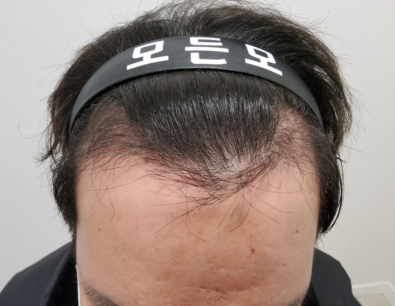 2. 수술후_3개월.jpg