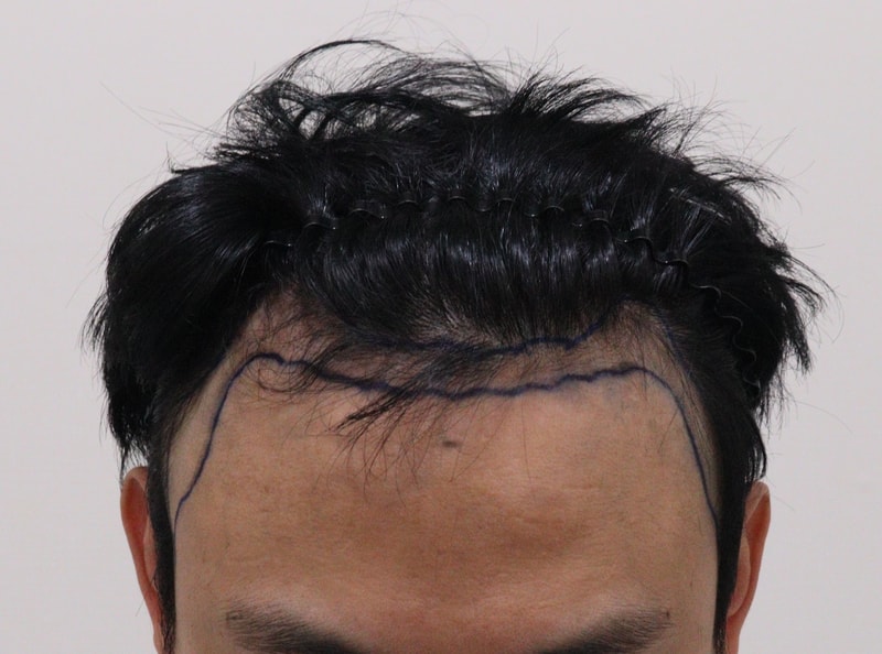 1. 수술전_1.JPG