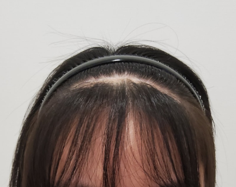 흉터이식, 육개월 지났습니다!