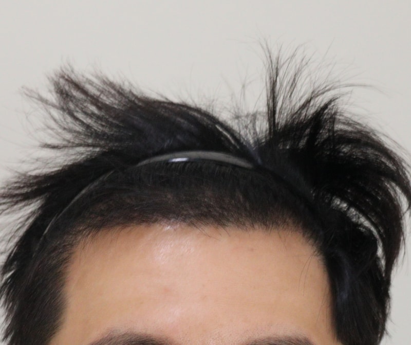 4. 수술후_5개월_1.JPG