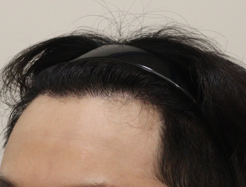 4. 수술후_6개월_3.JPG