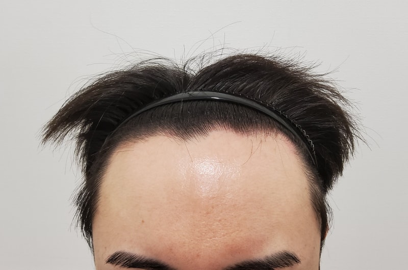 비절개모발이식 3개월차 진입니다ㅎㅎ