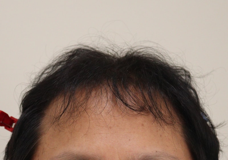 서울에서 모발이식한지 5개월 됐습니다.