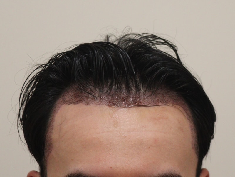 2. 수술후_1일_1.JPG