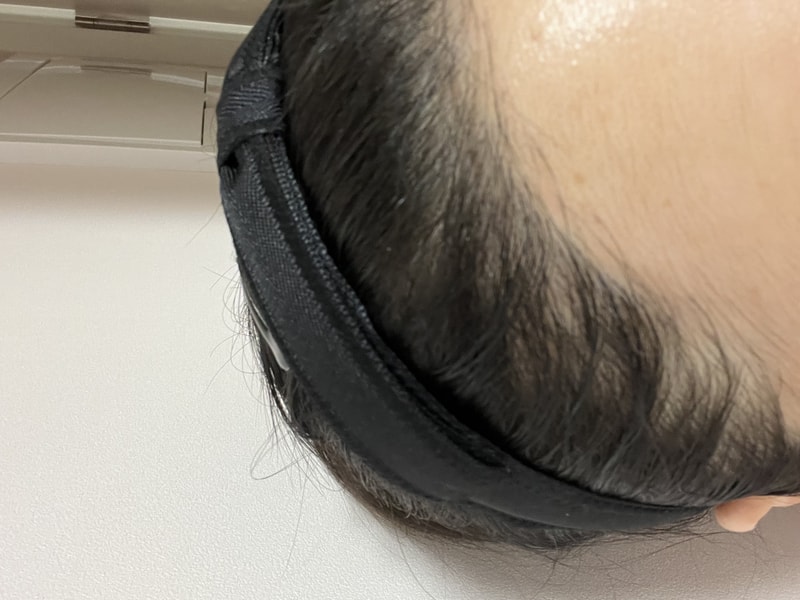 4. 수술후_6개월_셀카_2.jpeg