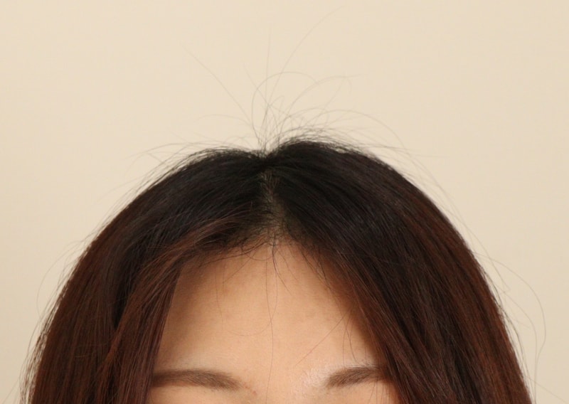 3. 수술후_3개월_2.JPG