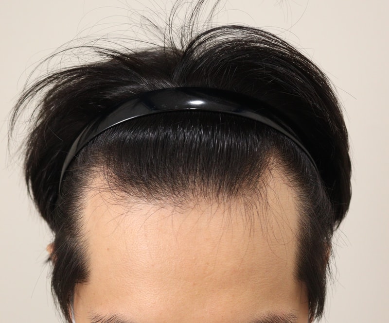 1. 수술전_1.JPG