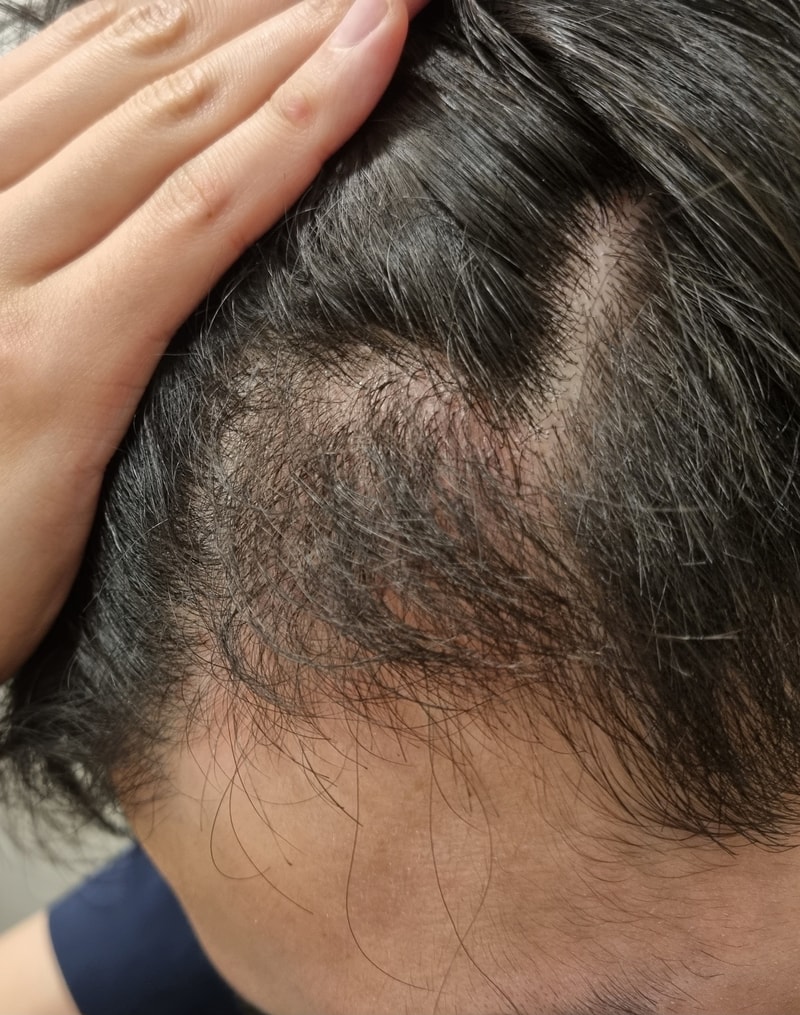 3. 수술후_3개월_셀카1.jpg