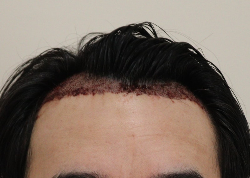 2. 수술후_1일_1.JPG