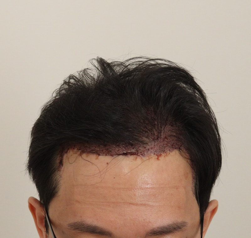 2. 수술후_1일_1.JPG