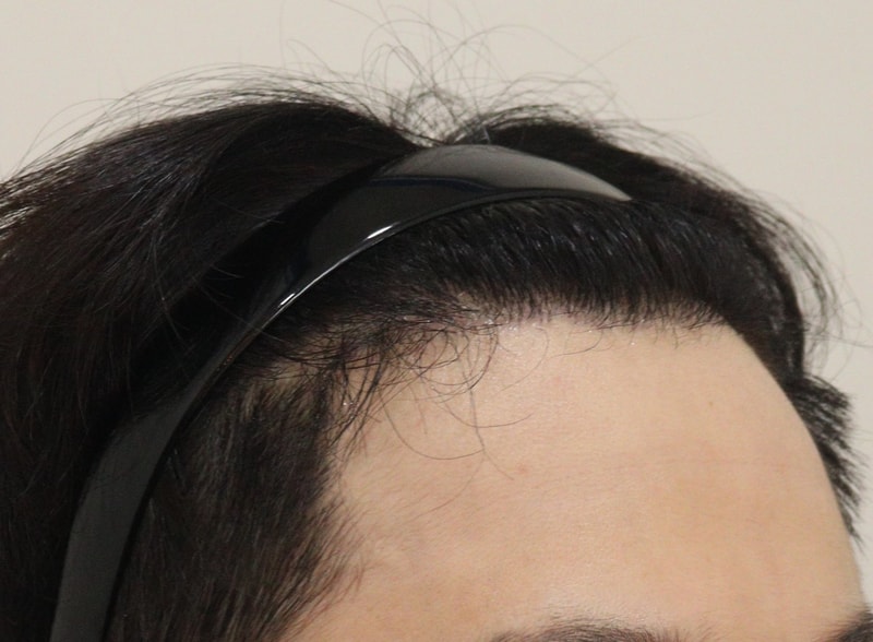 4. 수술후_6개월_4.JPG