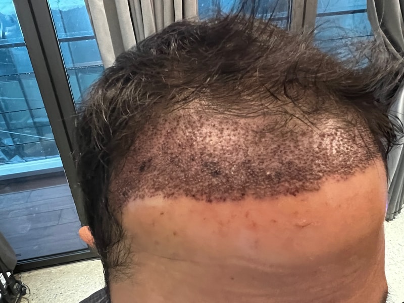 2. 수술후_1일_3.jpg