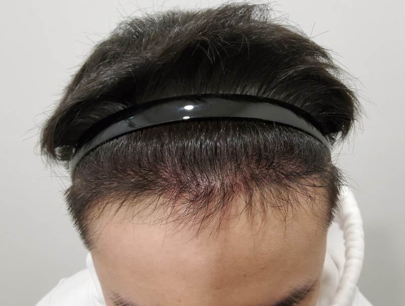 4. 수술후_6개월_1.jpg