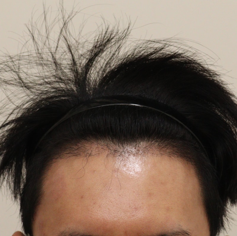 3. 수술후_3개월_1.JPG