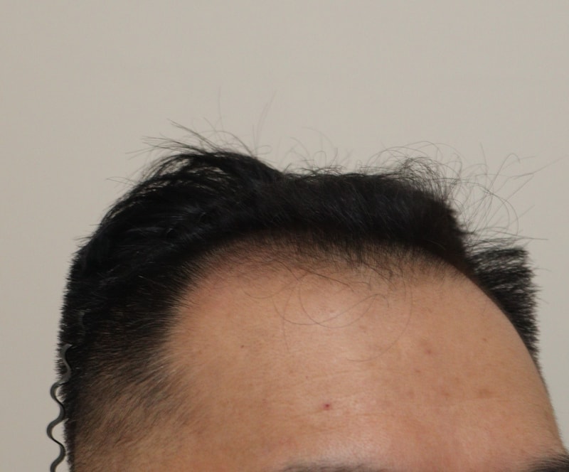 1. 수술전_4.JPG