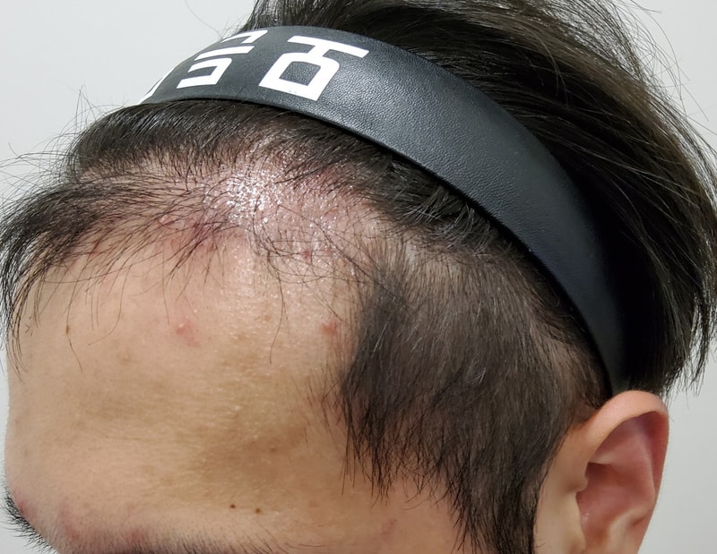 3. 수술후_3개월_2.jpg