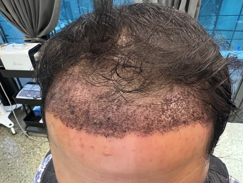 2. 수술후_1일_1.jpg