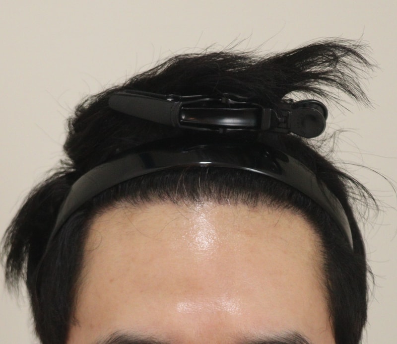 4. 수술후_6개월_1.JPG