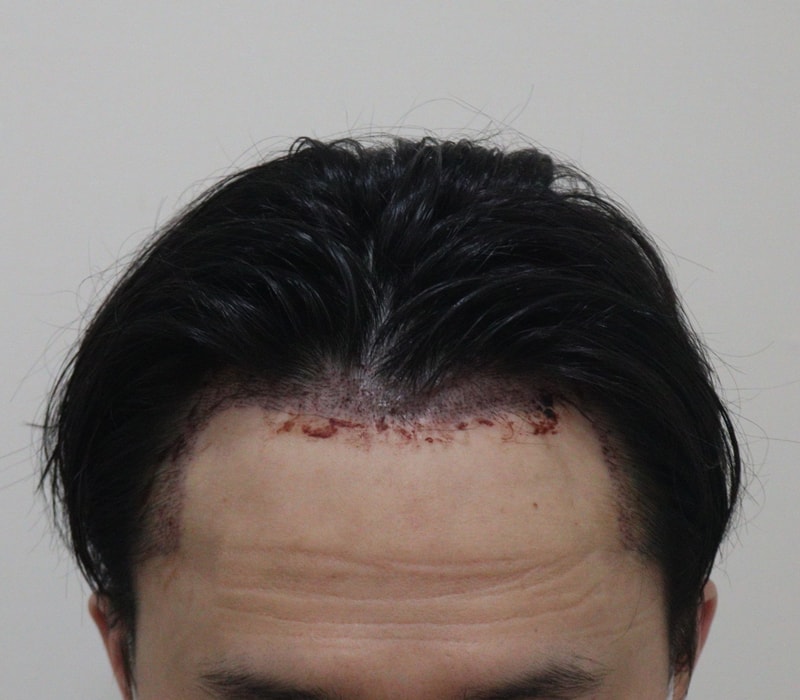 2. 수술후_1일_1.JPG