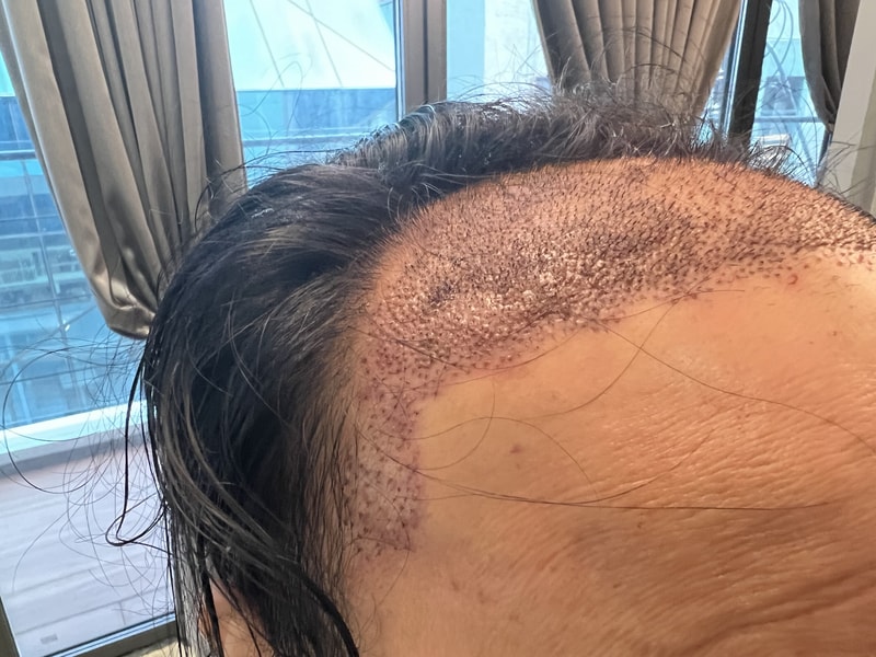 2. 수술후_1일_3.jpg