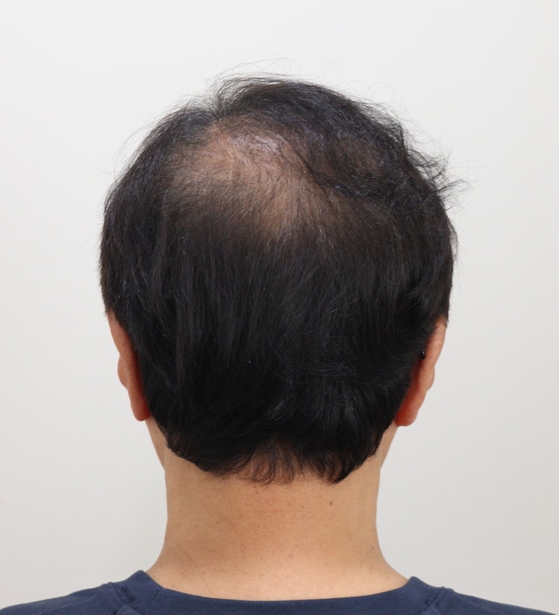 3. 수술후_3개월_1.JPG