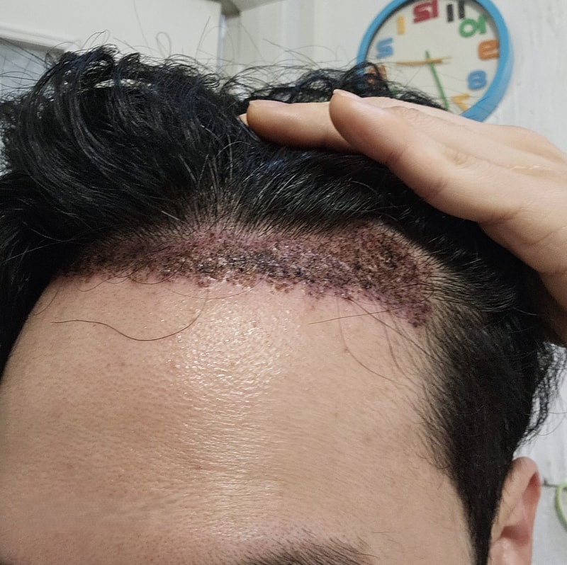 2. 수술후_2일_셀카_1.jpg