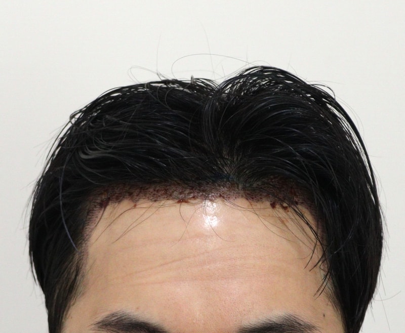 2. 수술후_1일_1.JPG